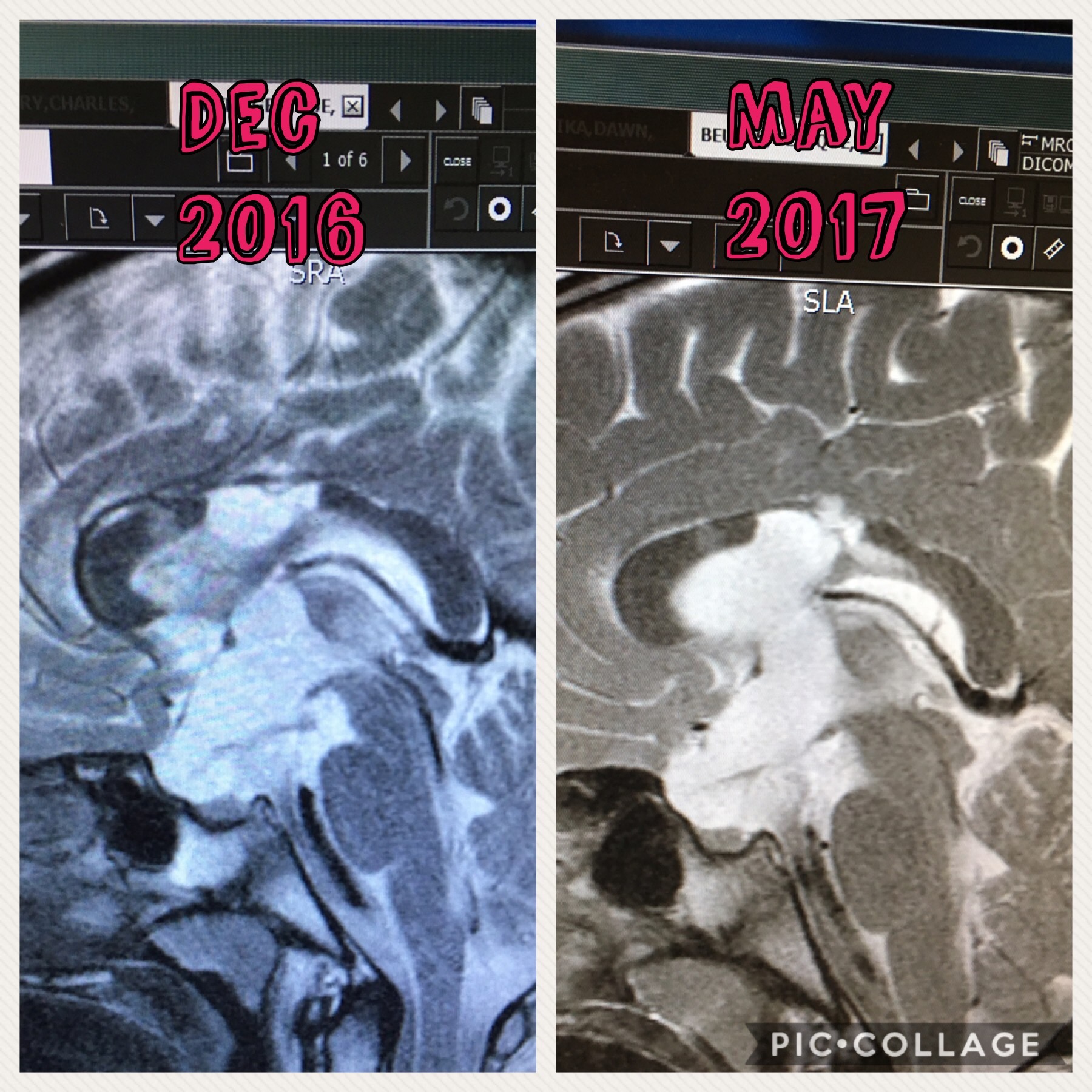 MRI Results